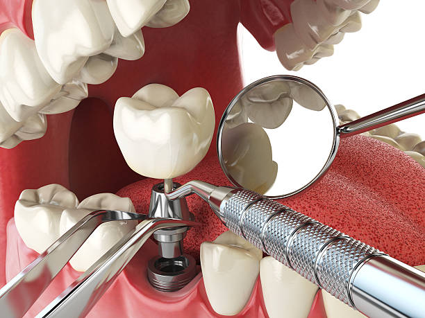 Best Emergency Tooth Extraction in Roessleville, NY